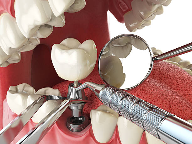 Best Emergency Tooth Extraction in Auburn, IL